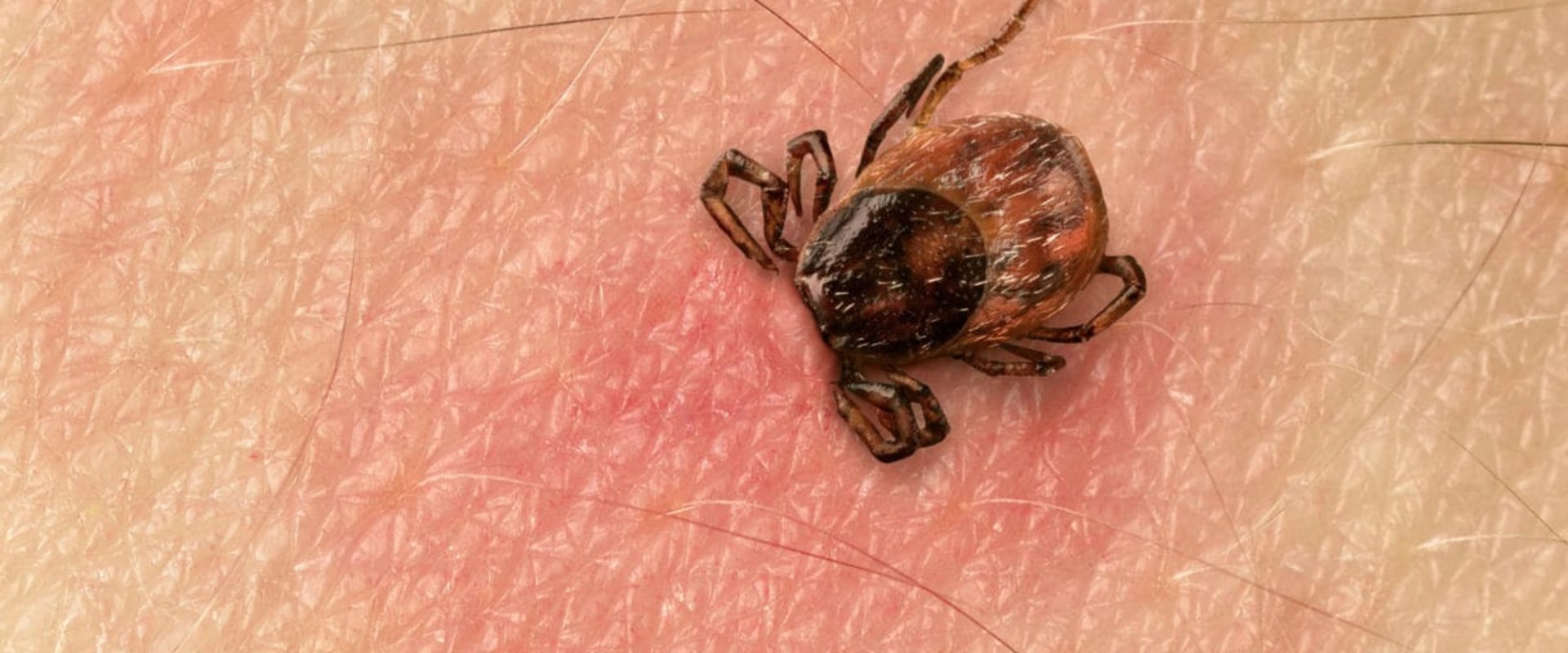 Diagnosing Common Insect-Borne Diseases